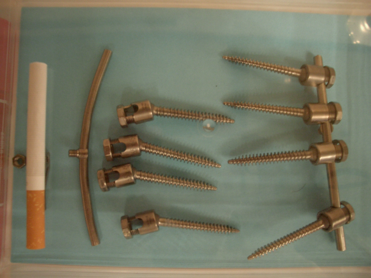脊柱管狭窄症の手術で使った金具